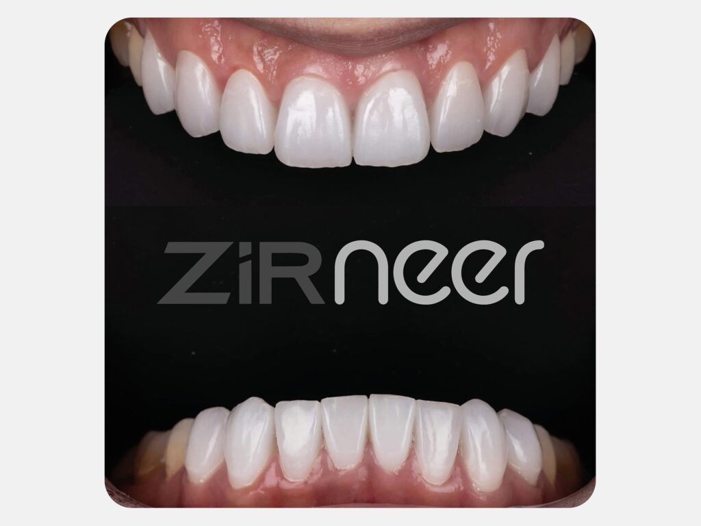 ZirNEER